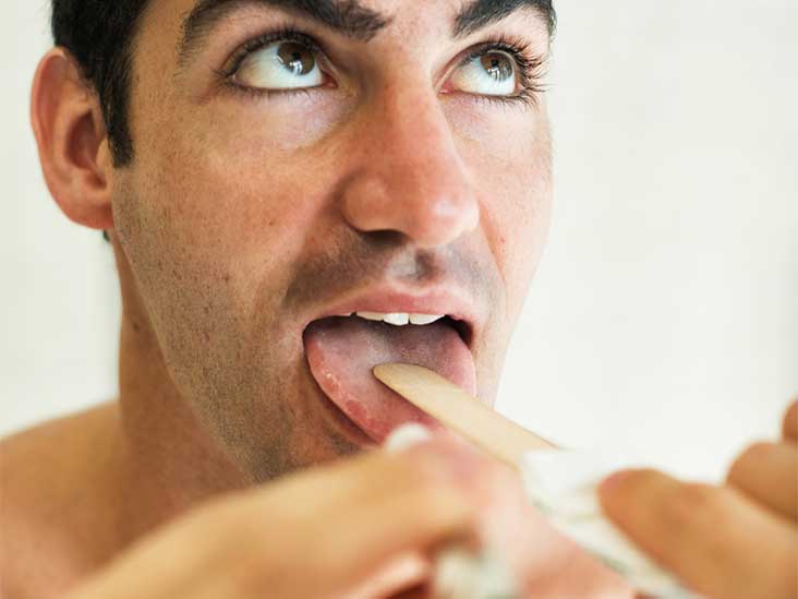Candidiasis in men in the mouth