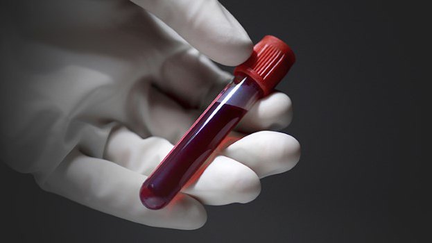 血液测试提升RDW这是什么意思