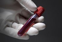 在血液测试RDW增加或减少是什么意思？
