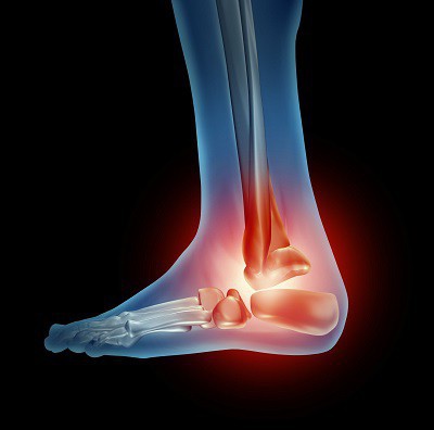 変形性関節症の足首関節