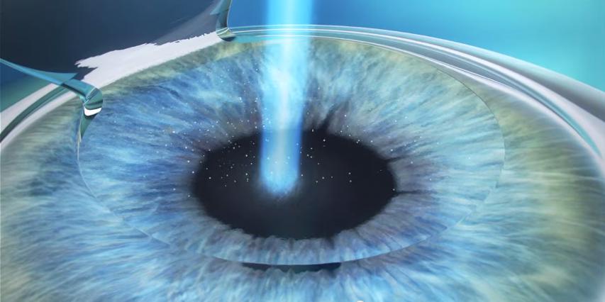 a laser para correção da visão