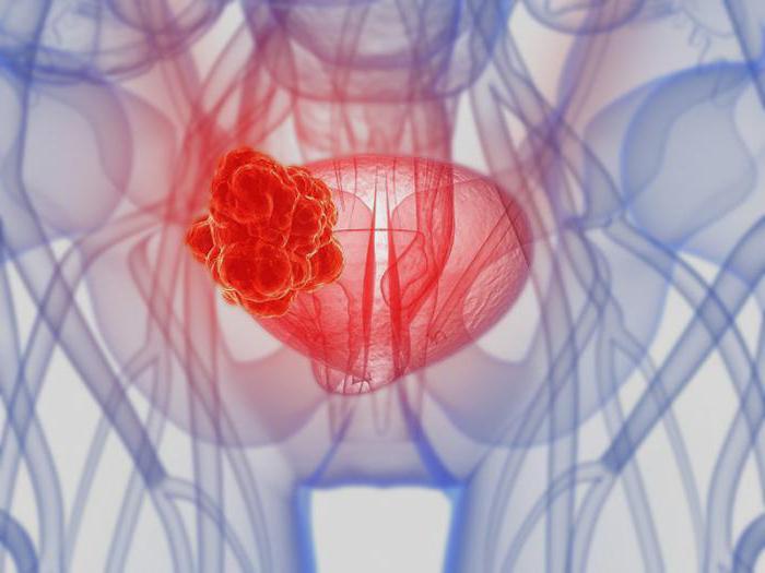 рак сечового міхура у чоловіків прогноз виживання