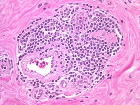 fibrocystic mastopathy of mammary glands treatment