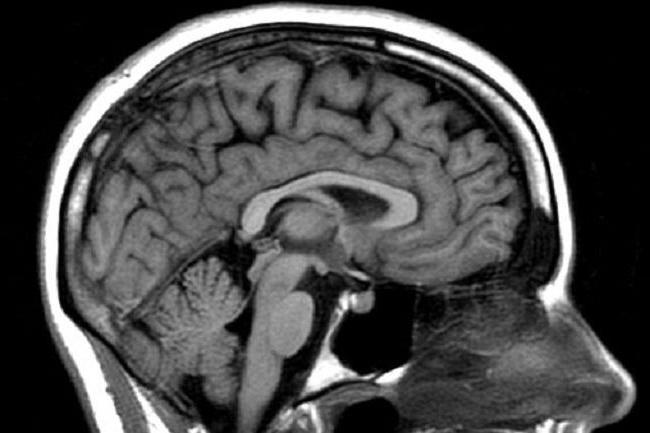 tomografia computadorizada ou ressonância magnética que é melhor para o cérebro
