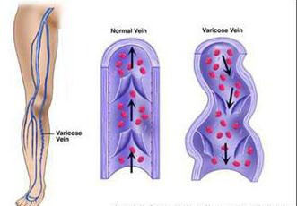 pantyhose to prevent varicose veins