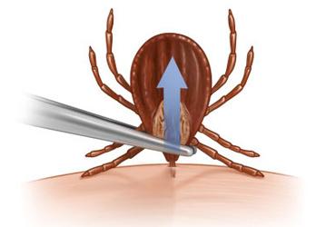 how to remove a tick from the body