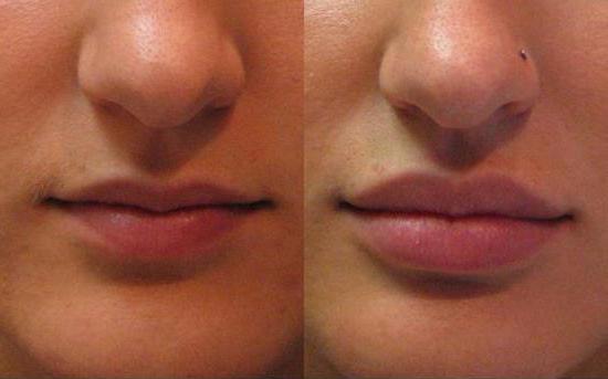 la toxina botulínica en la cosmetología de la foto de antes y después de la