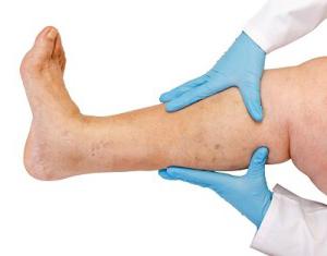  surgery for varicose veins 