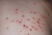 O molusco contagioso para a criança, tratamento de pele