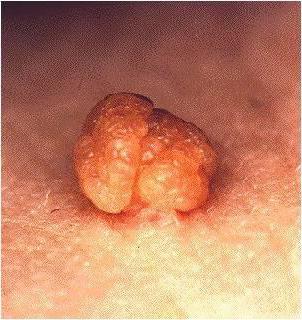 Papillome an der Brustwarze während der Schwangerschaft