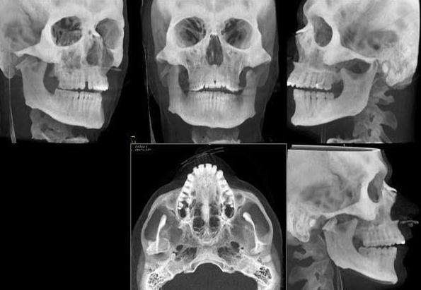 tomografia komputerowa szczęki zdjęcie zębów 3d
