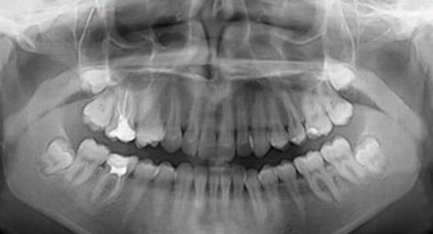 tomografia computadorizada de mandíbulas 3d