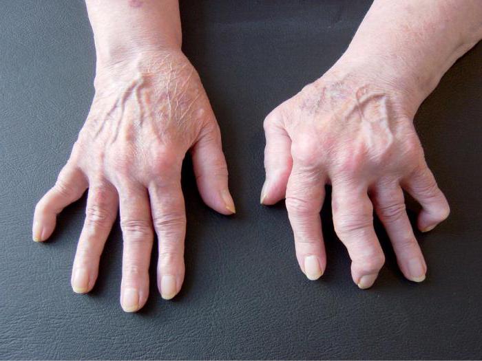 die ersten Symptome der rheumatoiden Arthritis der Finger