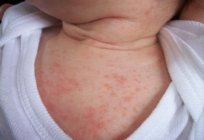 शरीर पर Pimples के बच्चे: कारणों, उपचार. लाल धक्कों के शरीर पर बच्चे