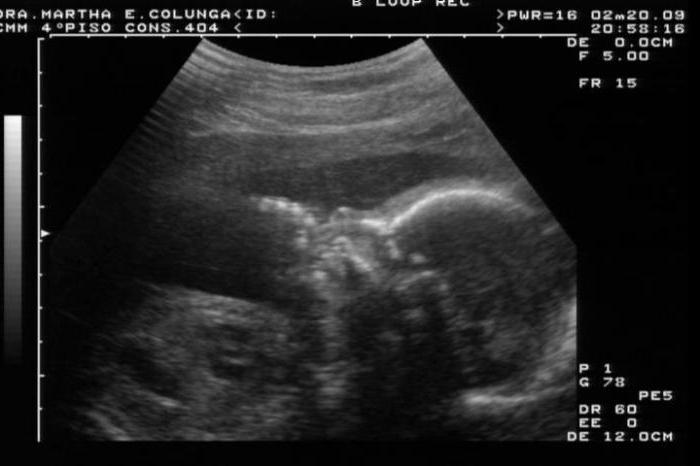 muestra si el ultrasonido de embarazo