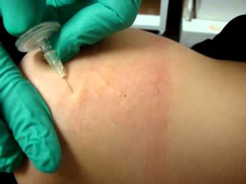 non-invasive carboxytherapy reviews