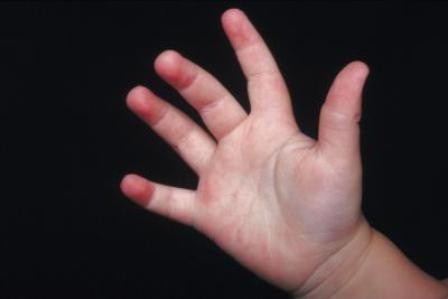 Rash bei Kindern an den Füßen und Händen