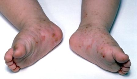 rash in children photo