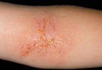 A symptom of any disease is a rash in a child on the hands and feet