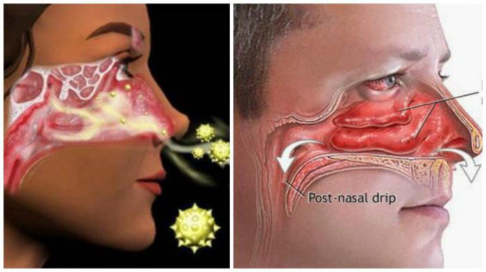 clínica anatomia do nariz, cavidade nasal