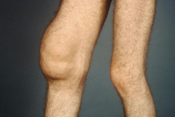 创伤后膜炎的膝关节