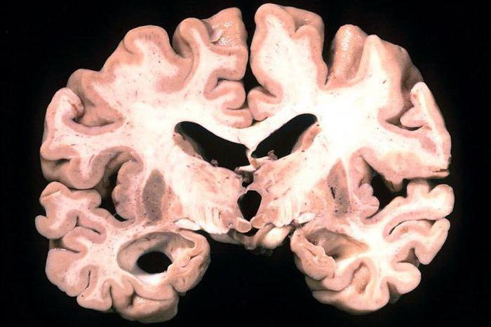хвороба паркінсона і альцгеймера