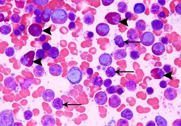 eosinophils in the blood increased