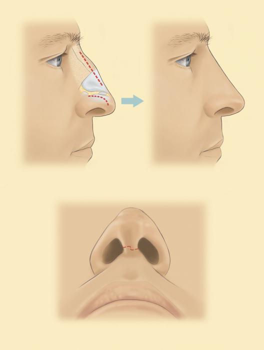 la punta de la nariz rinoplastia