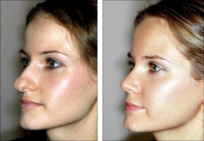 after rhinoplasty the nose