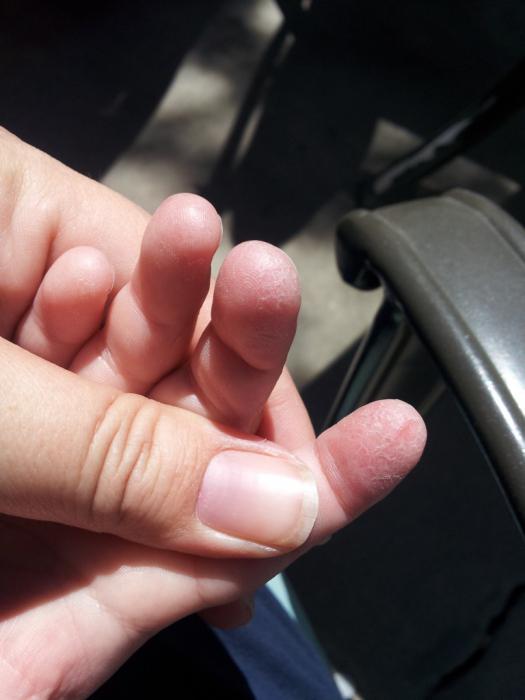 облазит Haut an den Fingern der Hände bei Kindern Ursachen