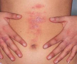 العنقوديات العدوى على الجلد العلاج