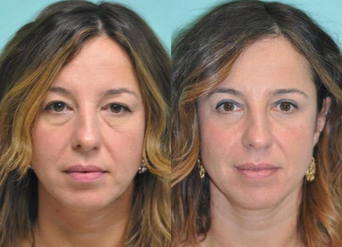 blepharoplastyの下のまぶたにモスクワ