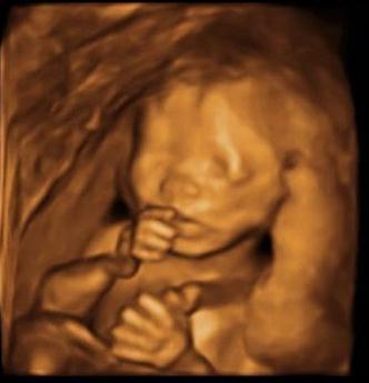 19 week gestation photo of fetus
