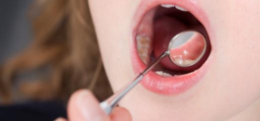 أعراض التهاب الفم في الأطفال