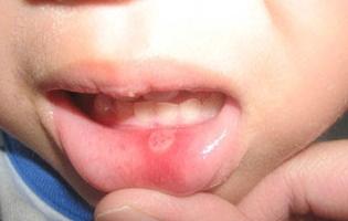 Stomatitis bei Kindern Ursachen