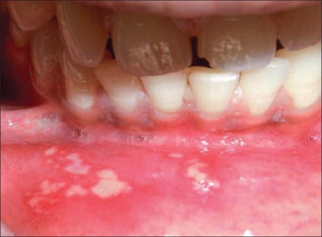 الفم في الأطفال العلاجات الشعبية