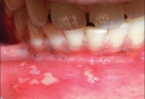Objawy zapalenia jamy ustnej u dzieci. Przyczyny, leczenie, profilaktyka