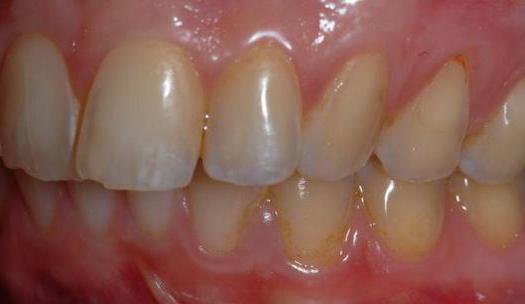 przyczyny problemów z zębami