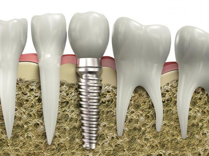 problemy z implantami zębów