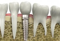 牙科的问题：原因和建议的一个医生