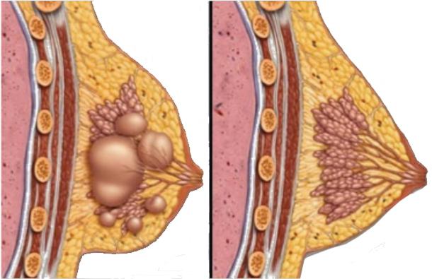 疾病的乳房