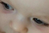¿Tienes moretones debajo de los ojos del bebé? Las razones deben buscarse junto con un médico