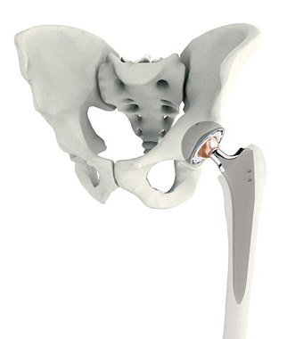 髋关节置换