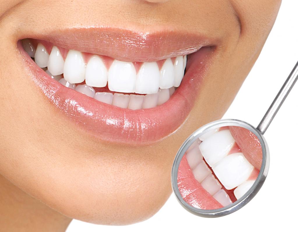 白化歯