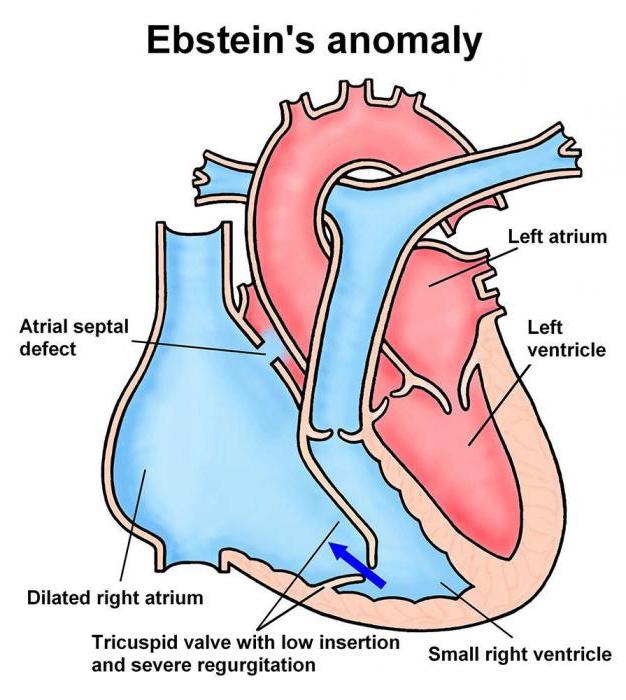 Ebstein的异常在成年人