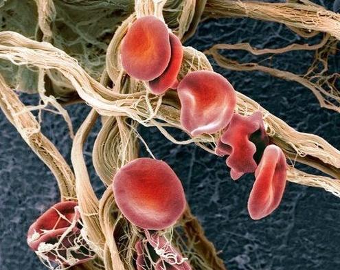 Yüksek kırmızı kan hücreleri