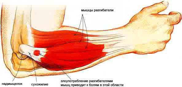 Tenderness of the elbow muscles