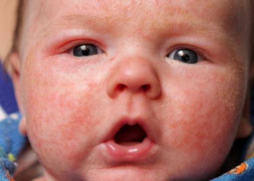 red rash on baby's face