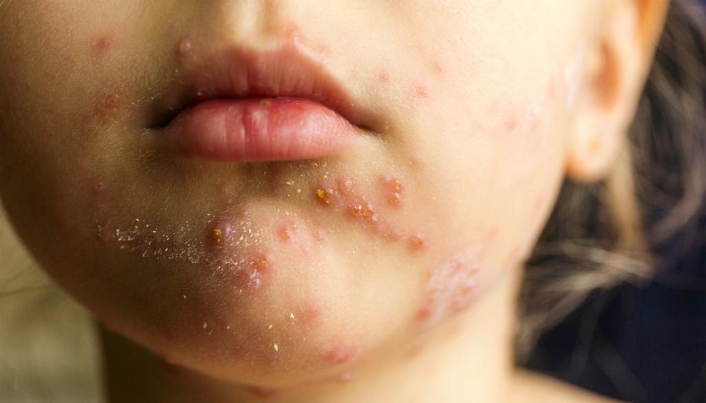 cómo curar el herpes en la cara