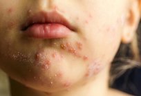 Herpes on the face: causes, symptoms and treatment